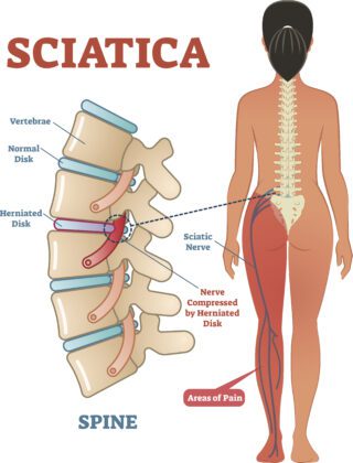 Sciatica-Pain